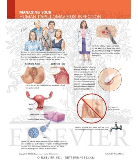Watermarked preview of labeled image: Managing Your Human Papillomavirus Infection