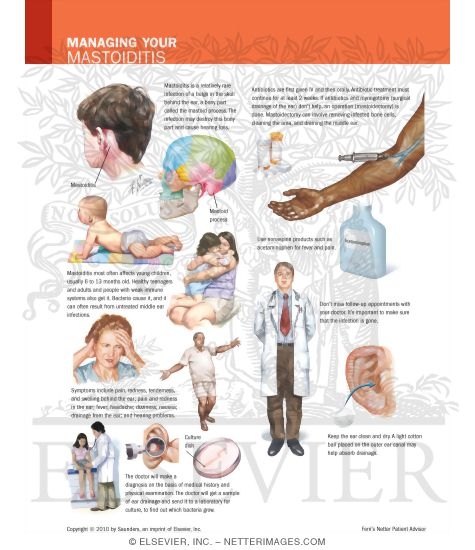 Managing Your Mastoidoitis