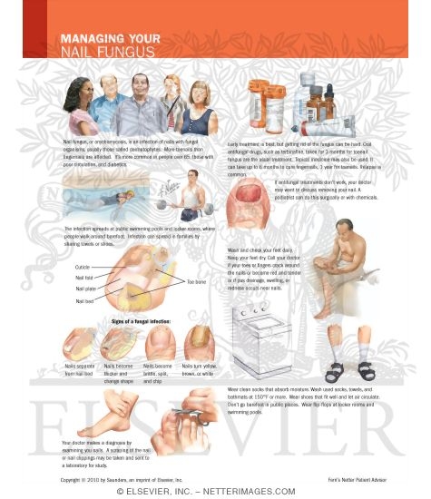 Watermarked preview of labeled image: Managing Your Nail Fungus