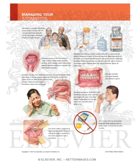 Managing Your Stomatitis