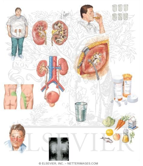 Managing Your Kidney Stones