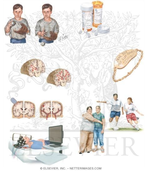 Watermarked preview of unlabeled image: Managing Your Absence Seizures