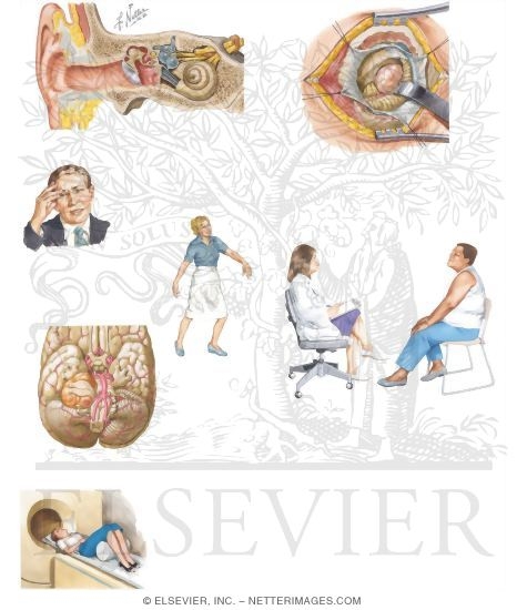 Watermarked preview of unlabeled image: Managing Your Acoustic Neuroma