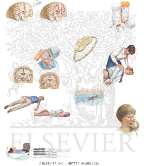 Managing Your Generalized Tonic-Clonic Seizures