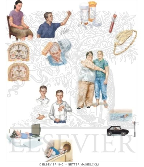 Watermarked preview of unlabeled image: Managing Your Partial Motor Seizures
