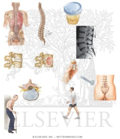 Watermarked preview of unlabeled image: Managing Your Spinal Stenosis