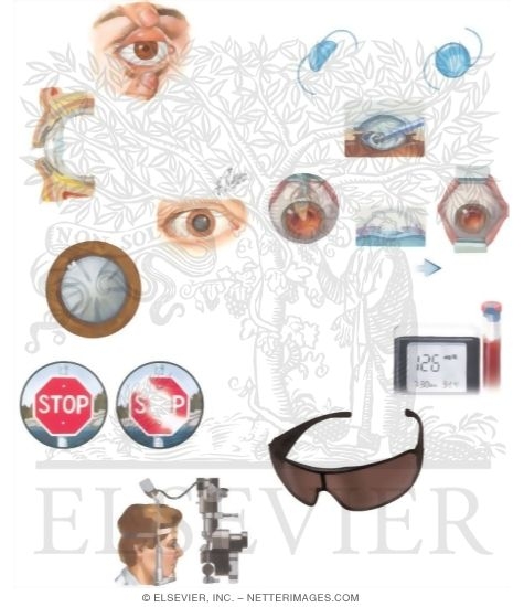 Watermarked preview of unlabeled image: Managing Your Cataracts