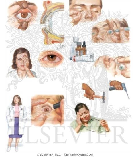 Watermarked preview of unlabeled image: Managing Your Corneal Foreign Body and Corneal Abrasion