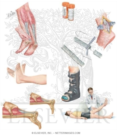 Watermarked preview of unlabeled image: Managing Your Achilles Tendon Rupture