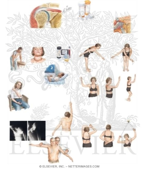 Watermarked preview of unlabeled image: Managing Your Frozen Shoulder
