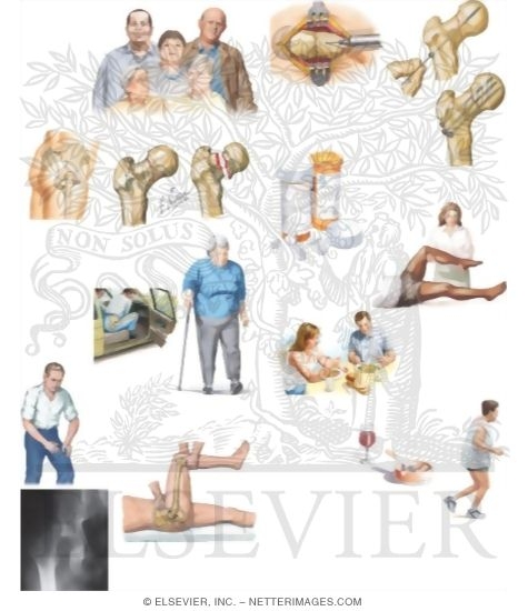 Watermarked preview of unlabeled image: Managing Your Hip Fracture