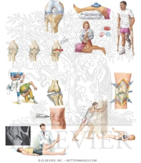 Watermarked preview of unlabeled image: Managing Your Knee Sprain
