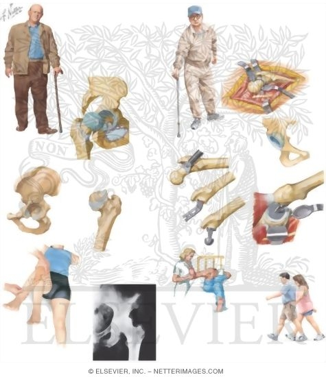 Watermarked preview of unlabeled image: Managing Your Osteoarthritis of the Hip