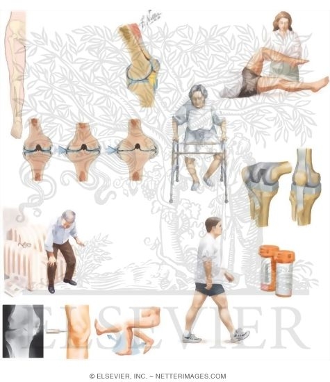 Watermarked preview of unlabeled image: Managing Your Osteoarthritis of the Knee