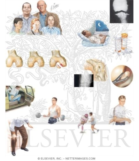 Watermarked preview of unlabeled image: Managing Your Osteochondritis Dissecans