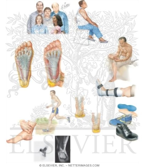 Watermarked preview of unlabeled image: Managing Your Plantar Fasciitis