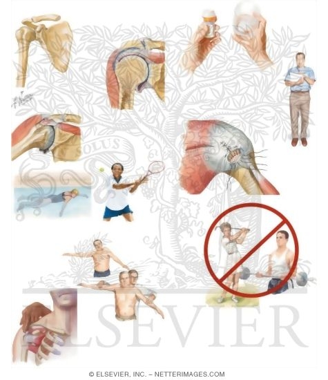 Watermarked preview of unlabeled image: Managing Your Rotator Cuff Pain