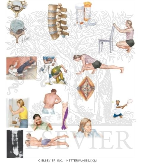 Watermarked preview of unlabeled image: Managing Your Slipped Disc