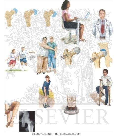 Watermarked preview of unlabeled image: Caring for Your Child With Slipped Femoral Epiphysis