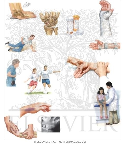 Managing Your Wrist Fracture
