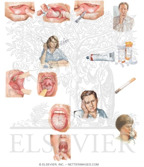 Watermarked preview of unlabeled image: Managing Your Oral Hairy Leukoplakia