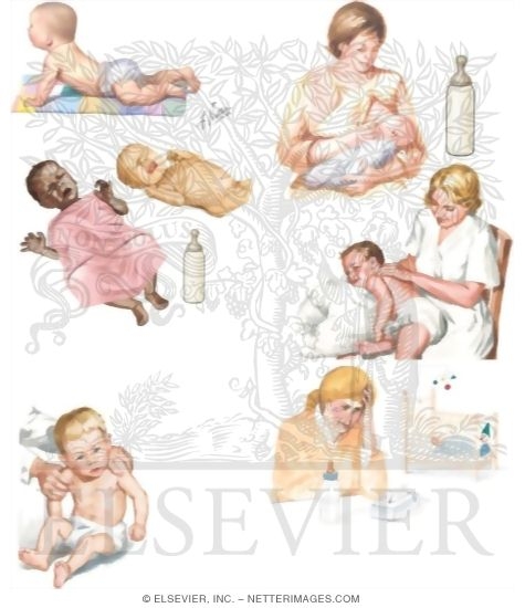 Caring for Your Infant With Colic