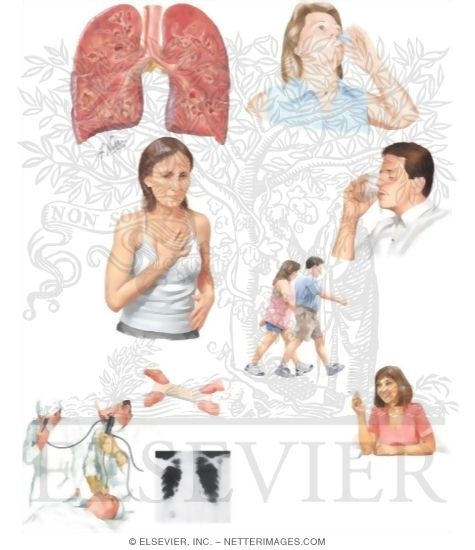 Watermarked preview of unlabeled image: Managing Your Bronchiectasis