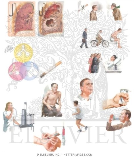 Watermarked preview of unlabeled image: Managing Your Emphysema