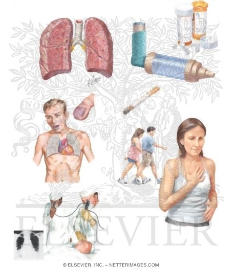 Managing Your Interstitial Pulmonary Disease