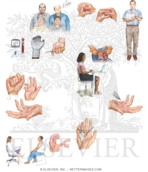 Watermarked preview of unlabeled image: Managing Your Dupuytren's Contracture