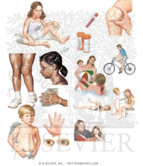 Caring for Your Child With Juvenile Rheumatoid Arthritis