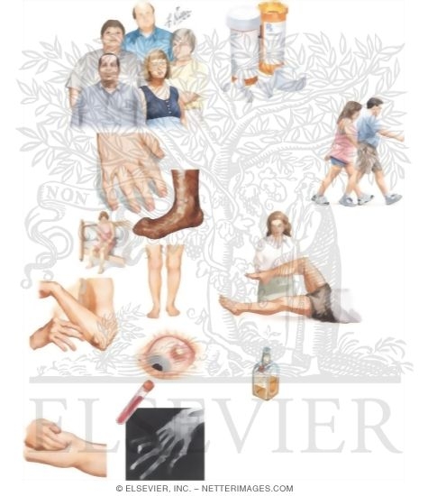 Watermarked preview of unlabeled image: Managing Your Rheumatoid Arthritis