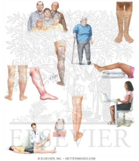 Watermarked preview of unlabeled image: Managing Your Varicose Veins