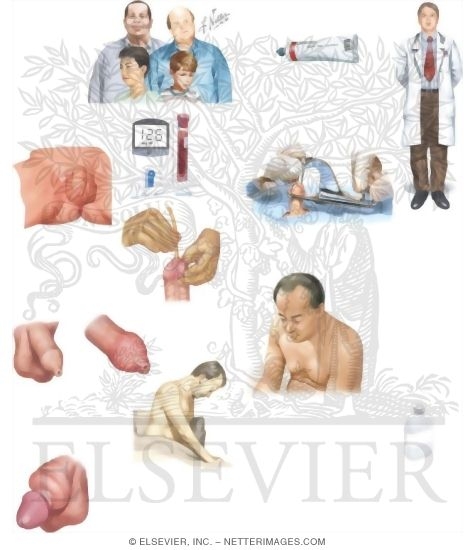 Managing Your Phimosis and Paraphimosis