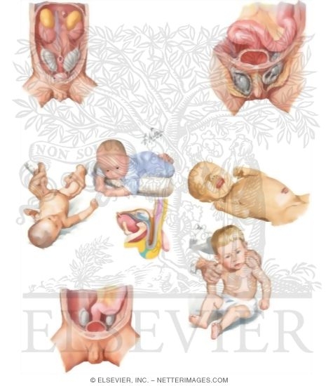 Caring For Your Child Born With An Undescended Testicle