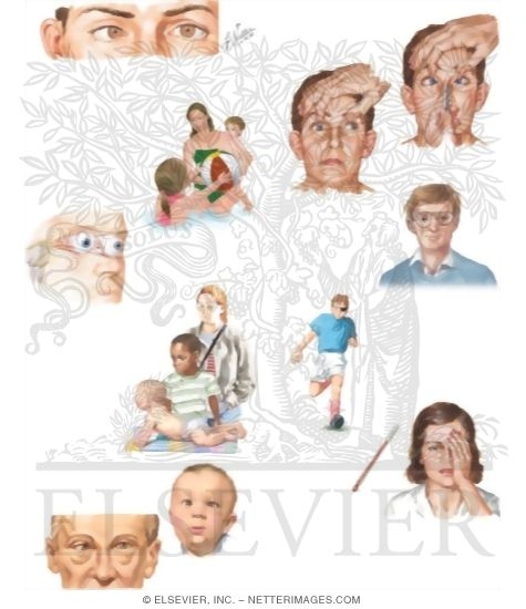 Watermarked preview of unlabeled image: Managing Your Strabismus