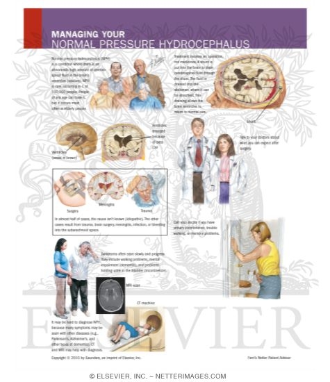 Watermarked preview of labeled image: Managing Your Normal Pressure Hydrocephalus