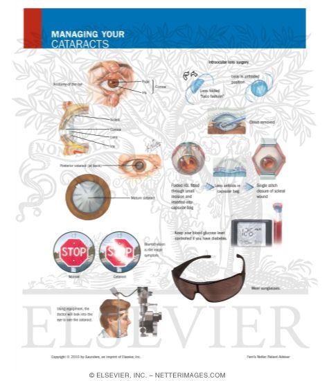 Watermarked preview of labeled image: Managing Your Cataracts