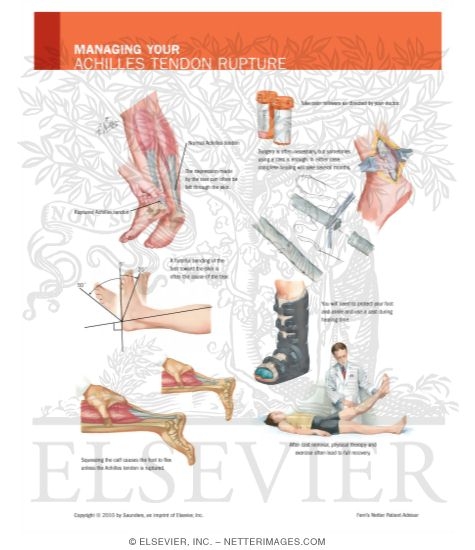 Watermarked preview of labeled image: Managing Your Achilles Tendon Rupture
