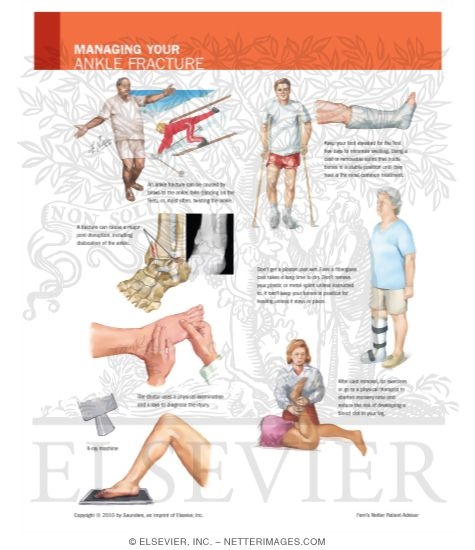 Watermarked preview of labeled image: Managing Your Ankle Fracture