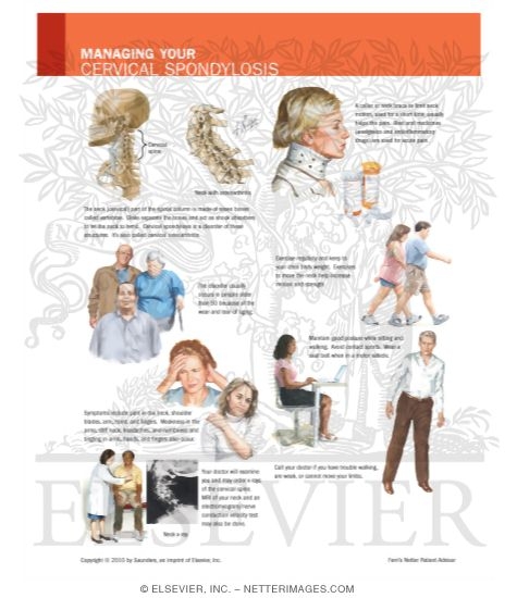 Watermarked preview of labeled image: Managing Your Cervical Spondylosis