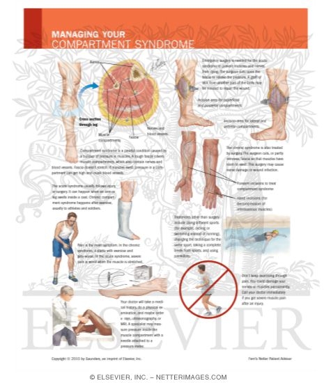 Watermarked preview of labeled image: Managing Your Compartment Syndrome