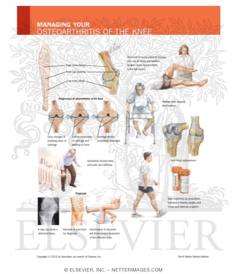 Watermarked preview of labeled image: Managing Your Osteoarthritis of the Knee
