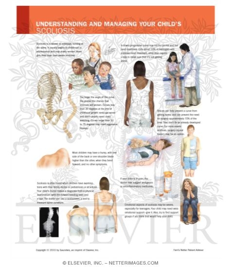 Watermarked preview of labeled image: Understanding and Managing Your Child's Scoliosis