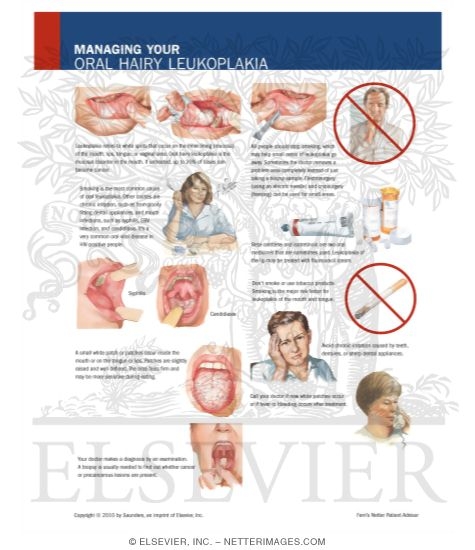 Managing Your Oral Hairy Leukoplakia