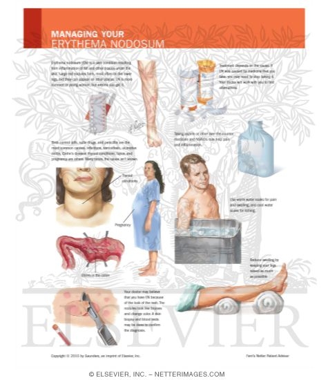 Watermarked preview of labeled image: Managing Your Erythema Nodosum
