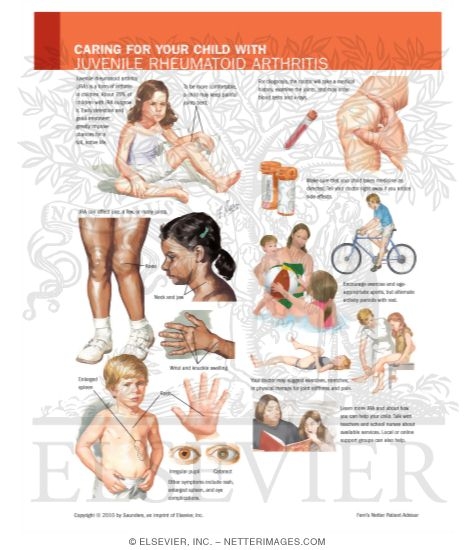 Caring for Your Child With Juvenile Rheumatoid Arthritis