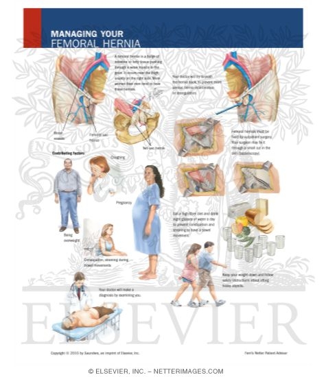 Watermarked preview of labeled image: Managing Your Femoral Hernia