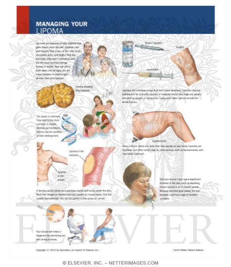Watermarked preview of labeled image: Managing Your Lipoma