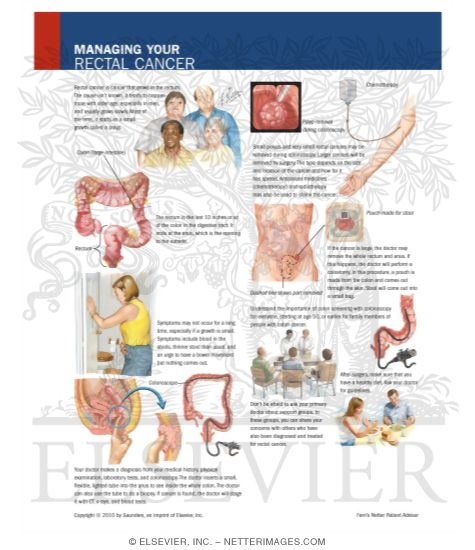 Watermarked preview of labeled image: Managing Your Rectal Cancer